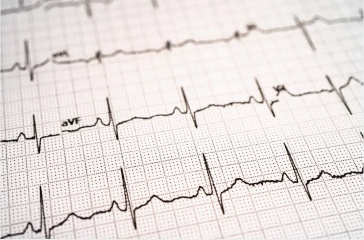 ECG