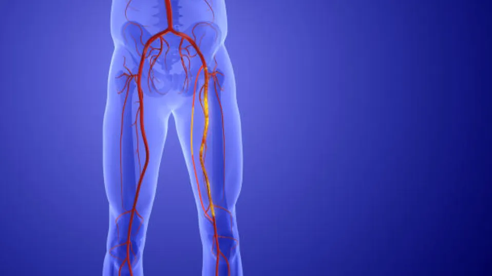 Lower Limb Angioplasty