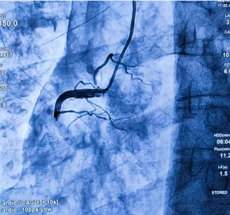 Primary PCI for Heart Attacks
