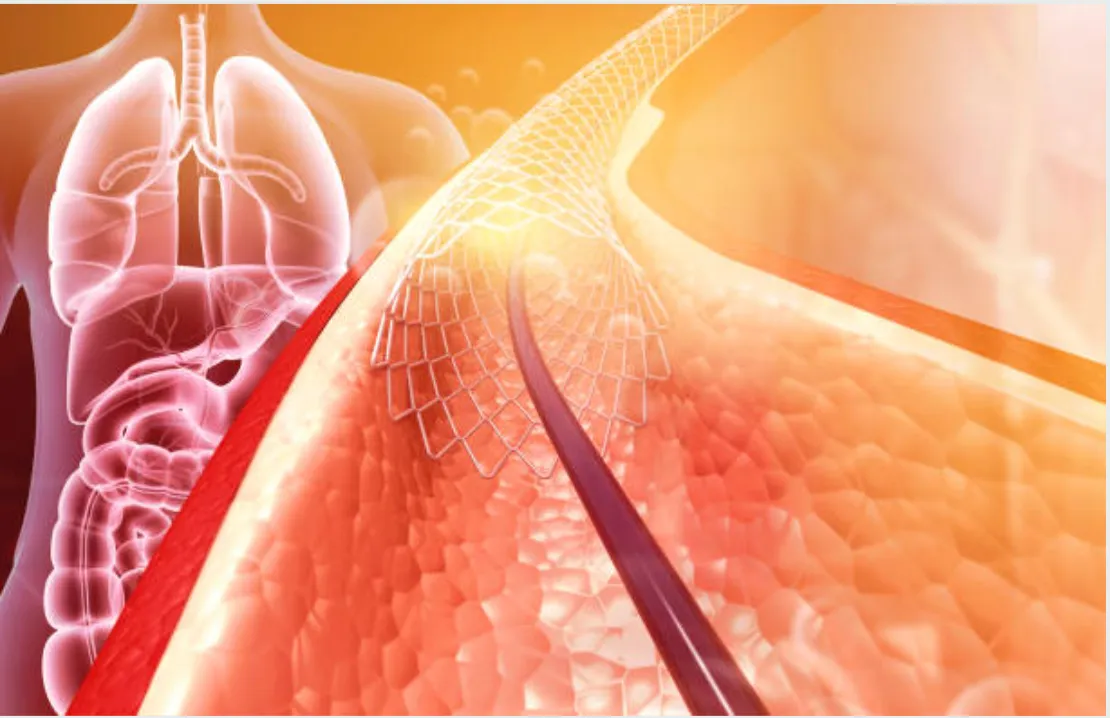 Renal Artery Intervention