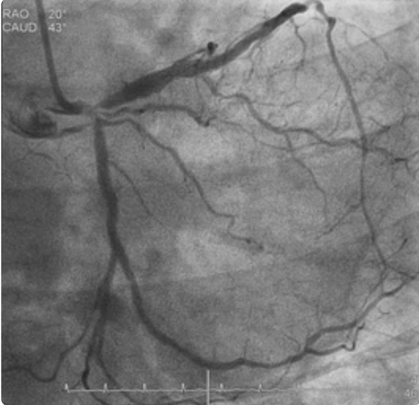 Left main PCI procedure illustration