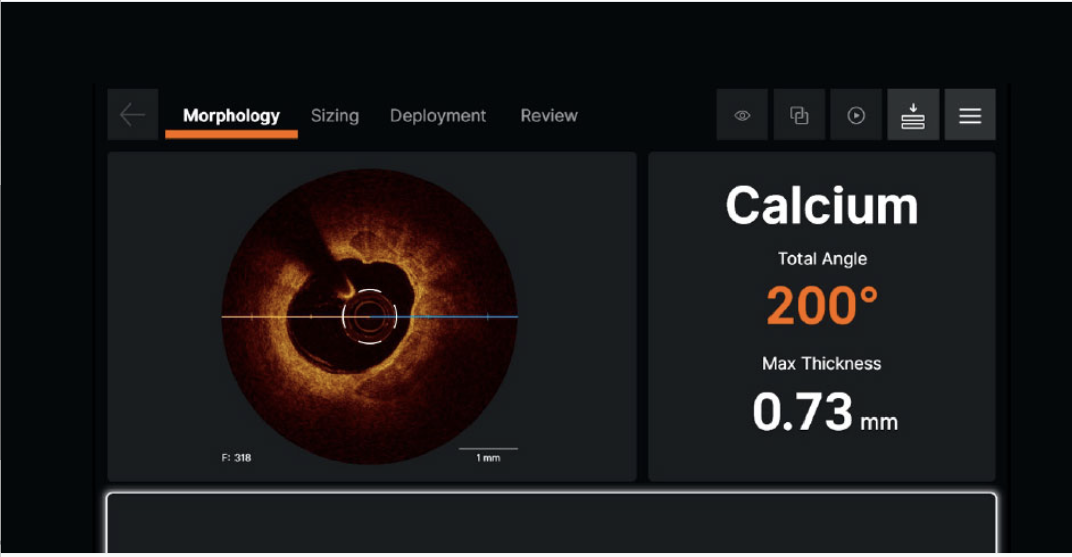 OCT console showing calcium analysis
