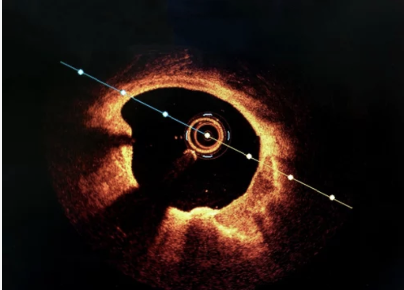 OCT cross-sectional image of coronary artery