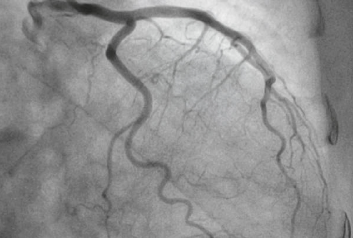 Coronary Angiography
