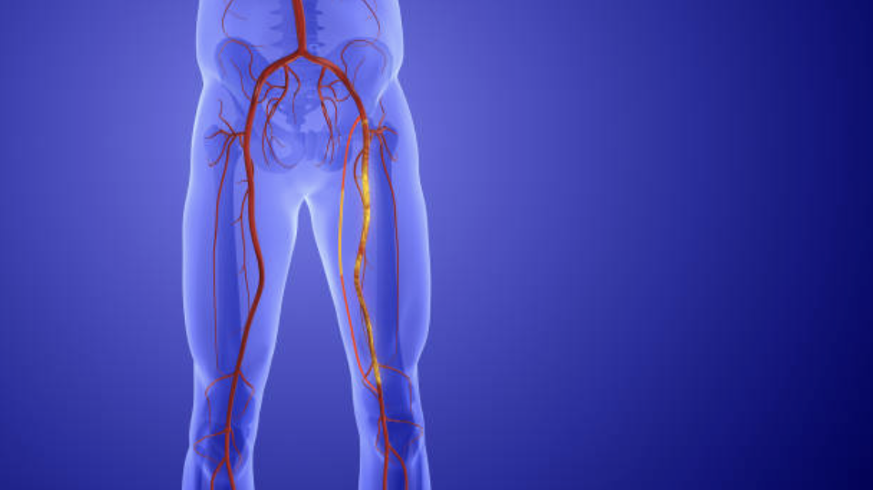 Lower Limb Angioplasty