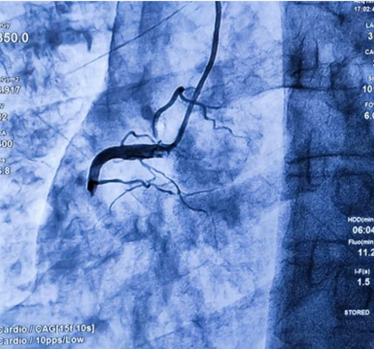 Primary PCI for Heart Attacks