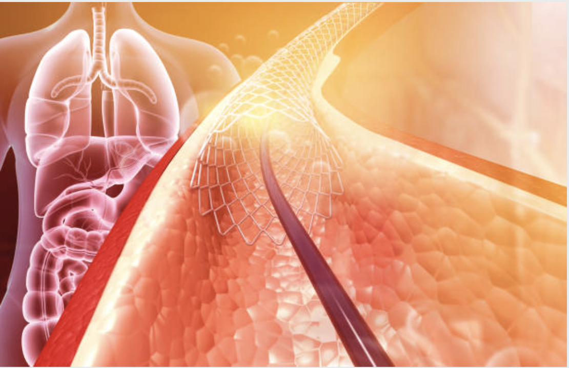 Renal Artery Intervention